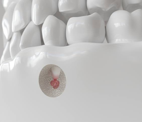 Illustration of hole created in jawbone to treat tooth root