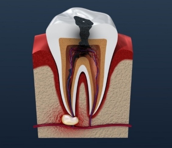 Illustrated decayed and infected tooth