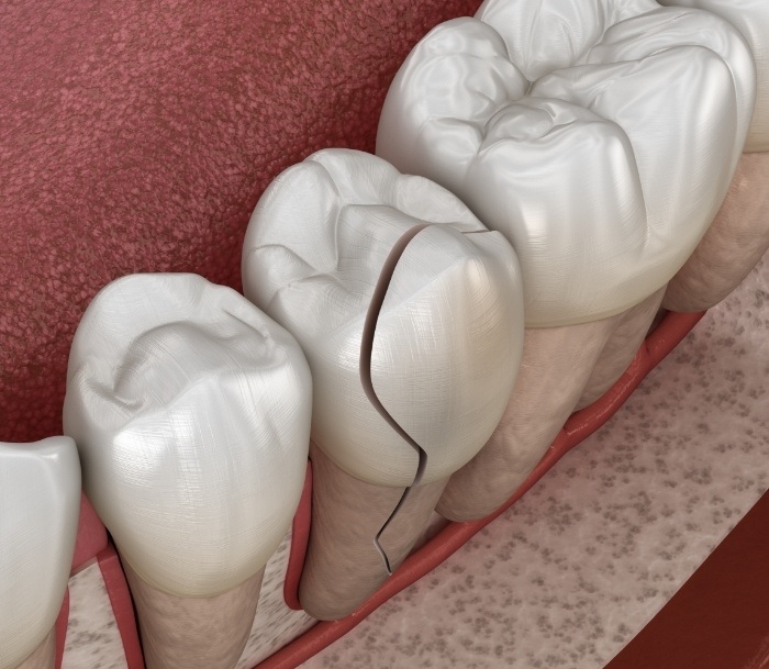 Illustrated broken tooth needing cracked tooth treatment in Paramus