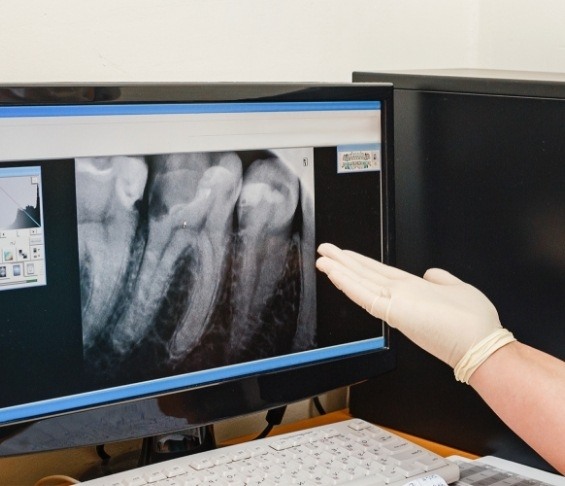 Gloved hand gesturing to computer monitor showing x ray of teeth