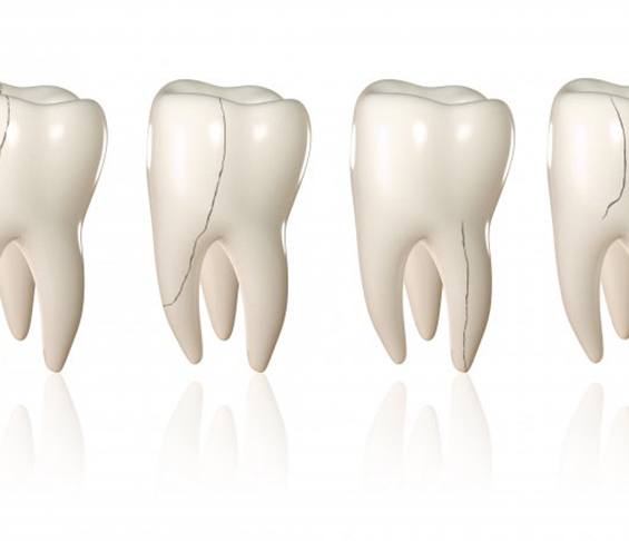 Digital image of four different teeth with different types of cracks