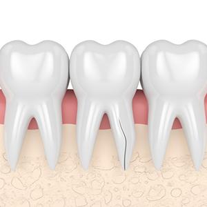 Digital image of a crack starting at the dental root